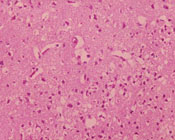 encephalitis_western